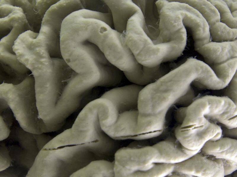 A study suggests Alzheimer's is virtually guaranteed for people who carry two copies of a risk gene. (AP PHOTO)